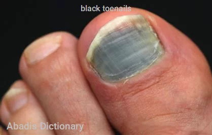 black toenails